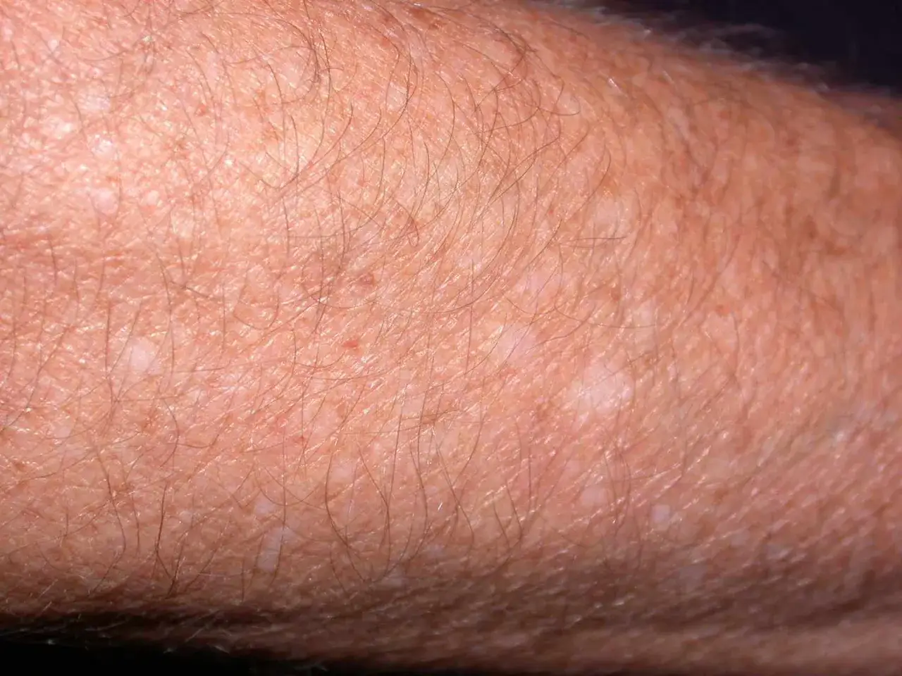 Gros plan sur une peau bronzée par le soleil, présentant une tache blanche, signe d'une exposition passée.
