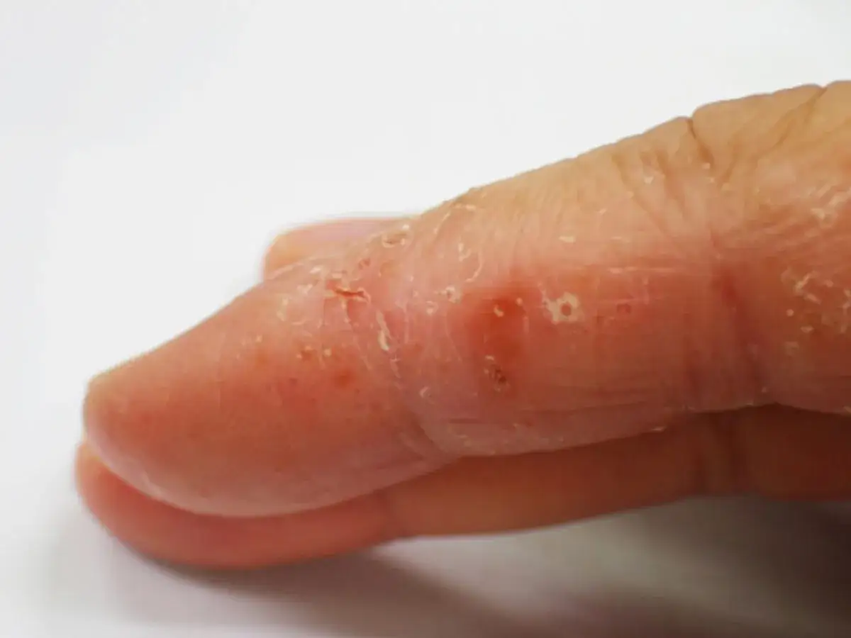 Doigt présentant des vésicules et une peau sèche, signes de dyshidrose main.