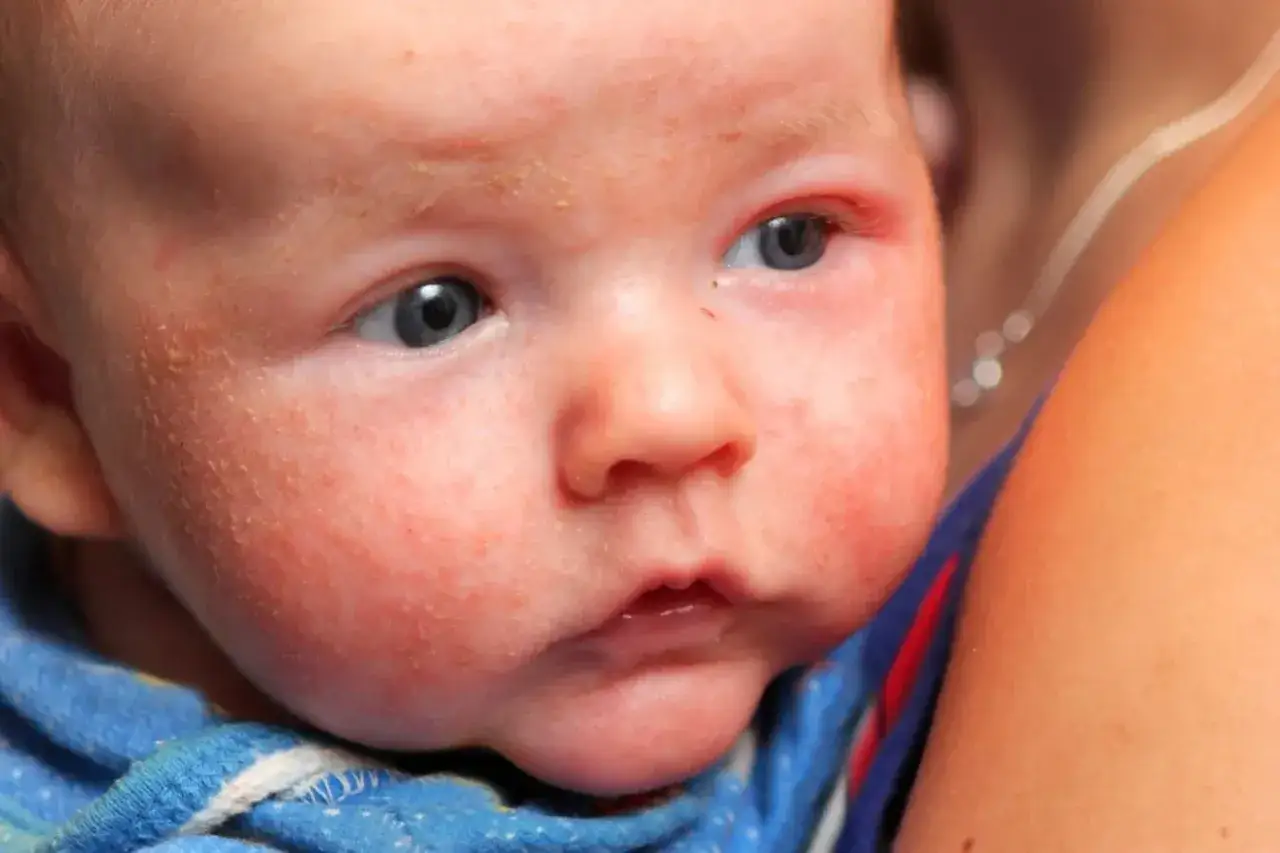 Visage d'un bébé aux joues rouges et irritées, présentant des signes d'eczéma.