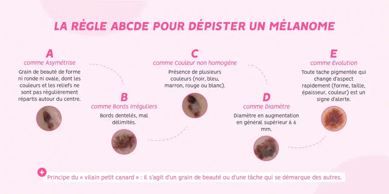 La règle ABCDE pour dépister un mélanome : Asymétrie, Bords irréguliers, Couleur non homogène, Diamètre, Évolution. Surveillez votre peau.