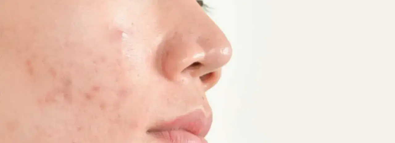 Gros plan sur une joue présentant des rougeurs et des imperfections, dont un comédon fermé.