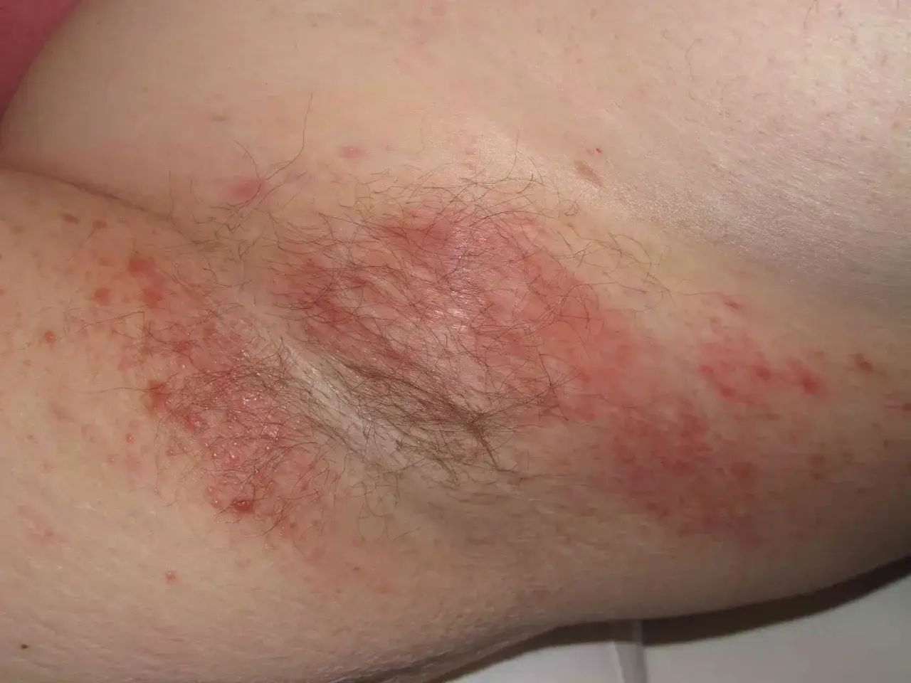 Irritation et rougeurs sur la peau, avec des petits boutons, typiques d'un eczema aisselle.