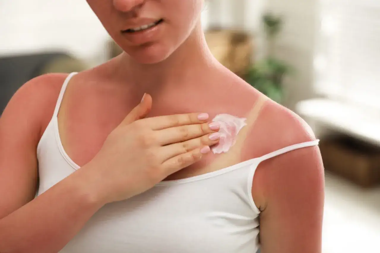 Une personne applique une crème apaisante sur un coup de soleil. Le Cicalfate aide à soulager la peau irritée par le soleil.