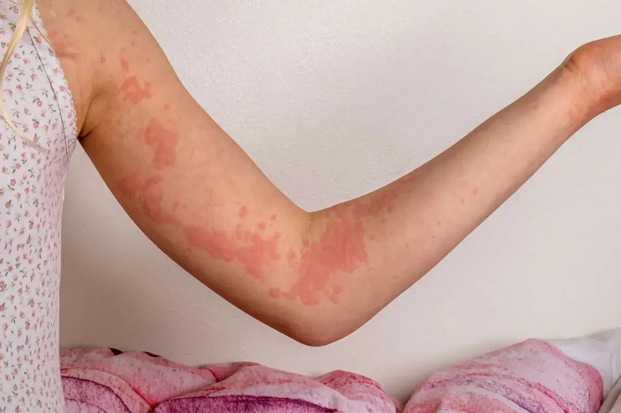 Bras couverts de plaques rouges et de petits boutons, signe d'une allergie cutanée.