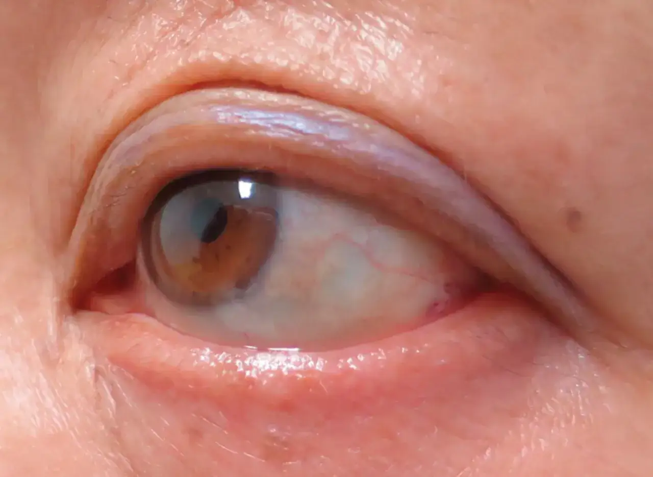 Gros plan sur un œil marron, montrant la peau ridée et une légère perte de cils.