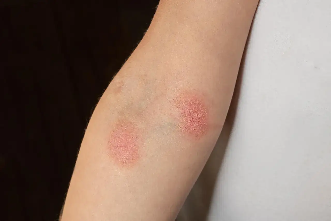 Plaques rouges et squameuses sur le bras, symptômes de dermatite atopique.