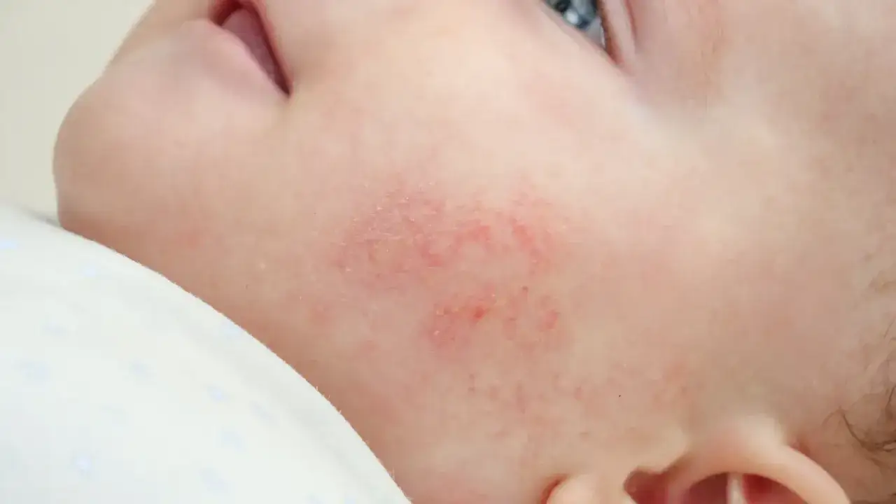 Psoriasis bébé : rougeurs et petites plaques sur la joue d'un nourrisson, nécessitant une attention particulière.