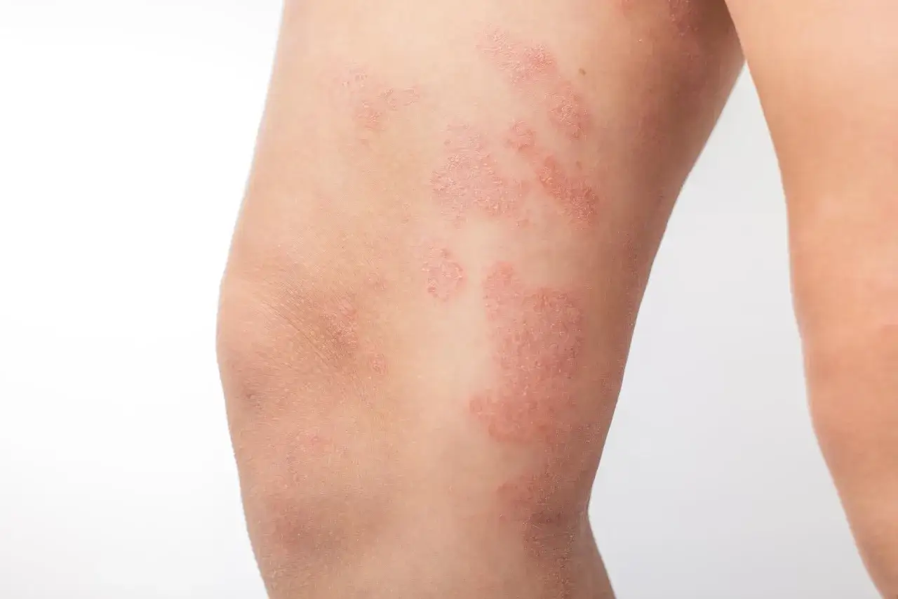 Plaques rouges et squameuses sur la cuisse, indiquant un eczéma cuisse. La peau est irritée et présente des zones sèches.