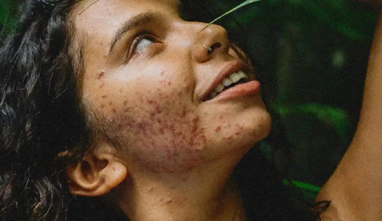 Visage d'une jeune femme aux prises avec une acné inflammatoire, regardant vers le ciel, entourée de verdure.