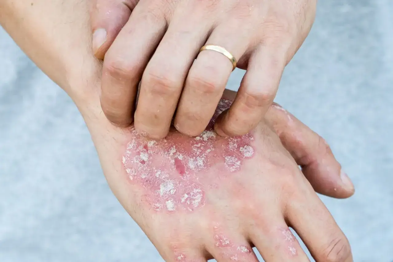 Main d'une personne se grattant des plaques rouges et squameuses, possiblement liées au psoriasis en goutte.