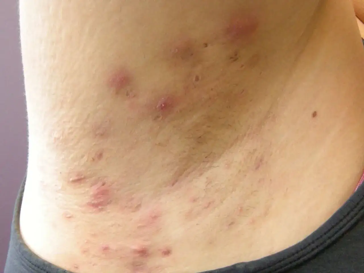 Gros plan sur des boutons sous les aisselles, certains rouges et enflammés, d'autres plus discrets. La peau est légèrement irritée.