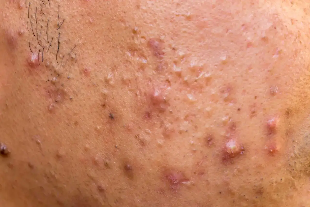 Gros plan sur une peau présentant des imperfections, des points noirs et un acné nodule rouge et enflammé.