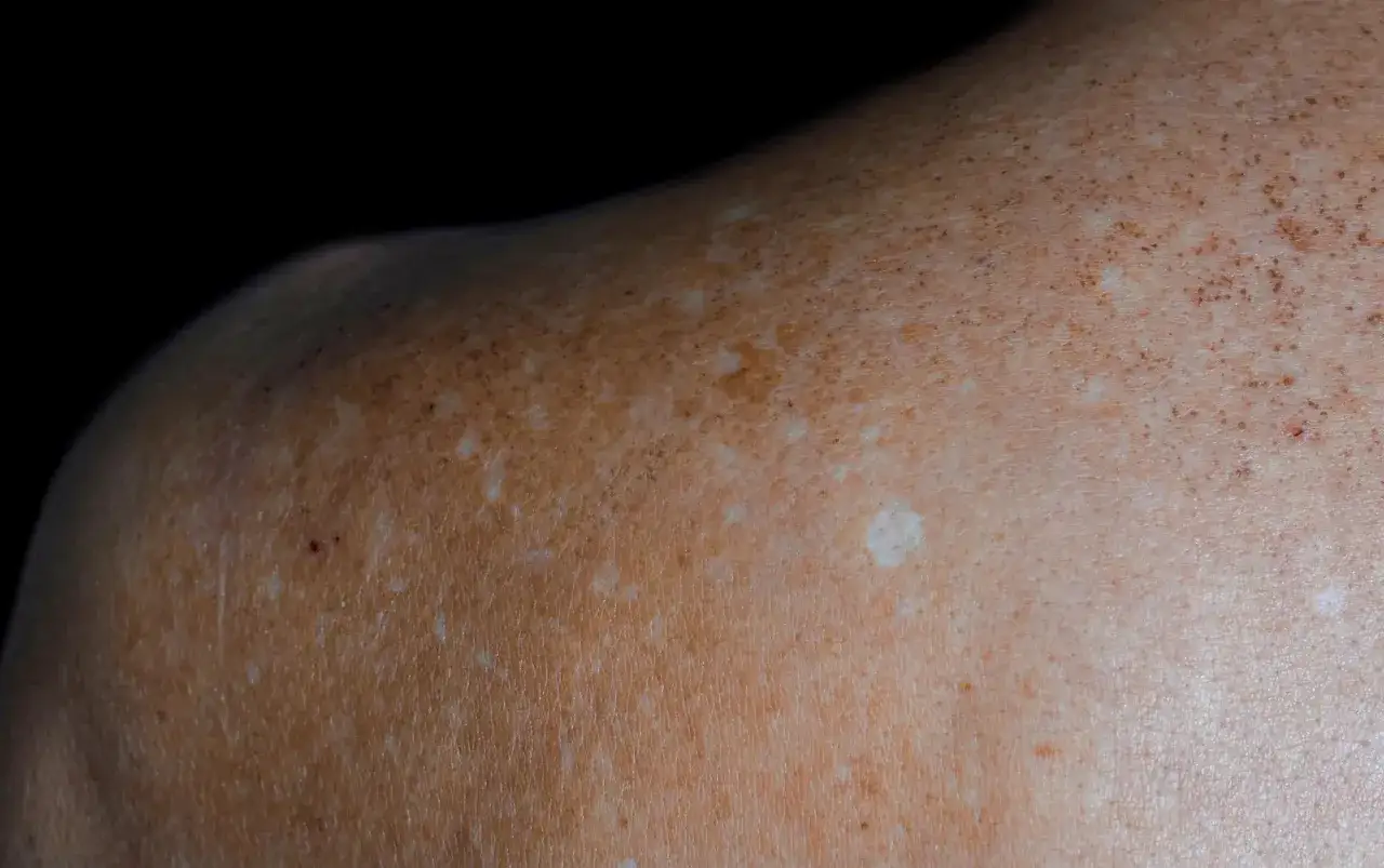 Gros plan sur une épaule montrant des taches sur les bras dues au soleil, avec des zones dépigmentées et des taches de rousseur.