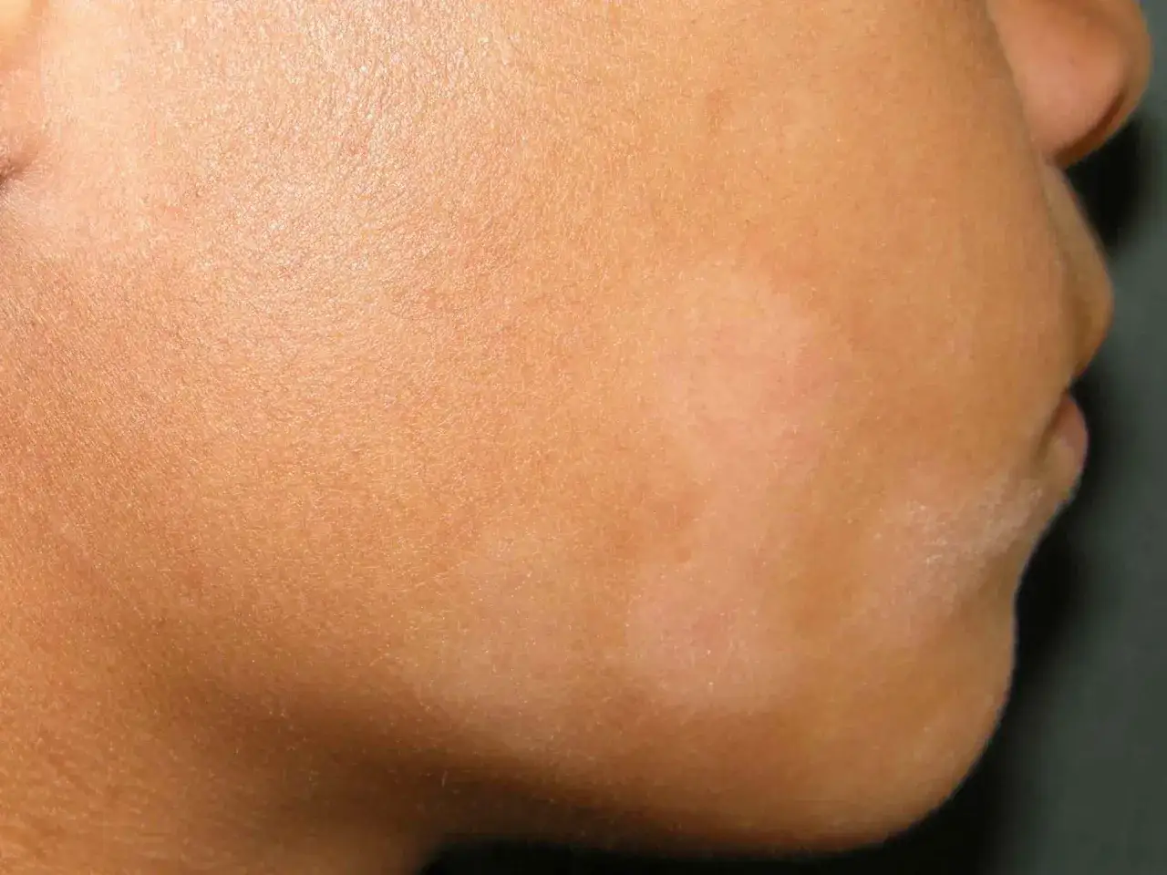 Gros plan sur une peau bronzée, révélant une légère plaque blanche sur la peau près de la mâchoire, contrastant avec le teint environnant.