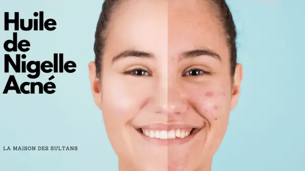 Visage divisé montrant une peau nette et une peau acnéique, avec le texte "Huile de Nigelle Acné".