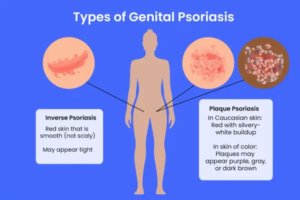Illustration des types de psoriasis génital, y compris le psoriasis inversé et le psoriasis en plaques, qui peuvent affecter le pénis.