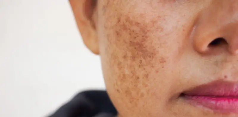 Gros plan sur une joue montrant une tache brune sur la peau, résultat d'une hyperpigmentation.