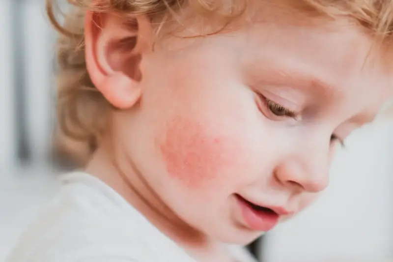 Un enfant avec une rougeur sur la joue, possiblement du pityriasis alba.